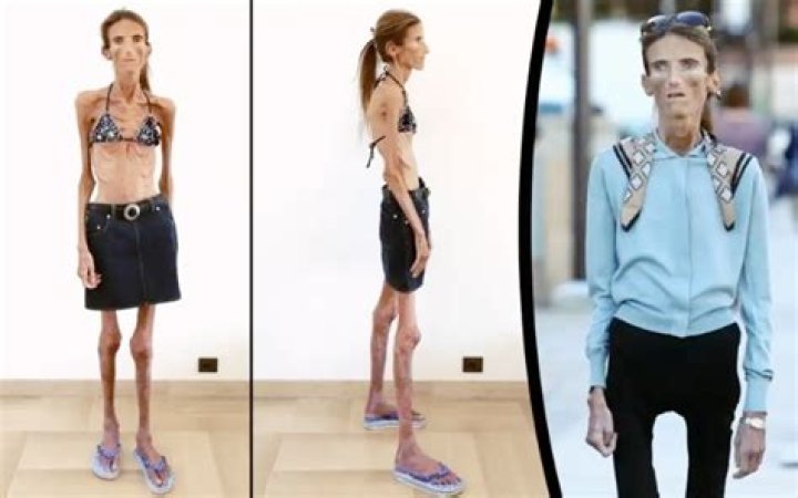 Skinniest Person In The World Facts And Stories